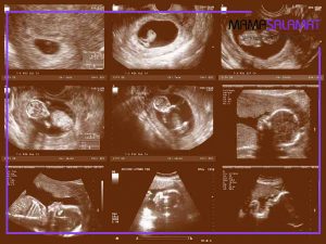سونوگرافی در بارداری-تصویر جنین