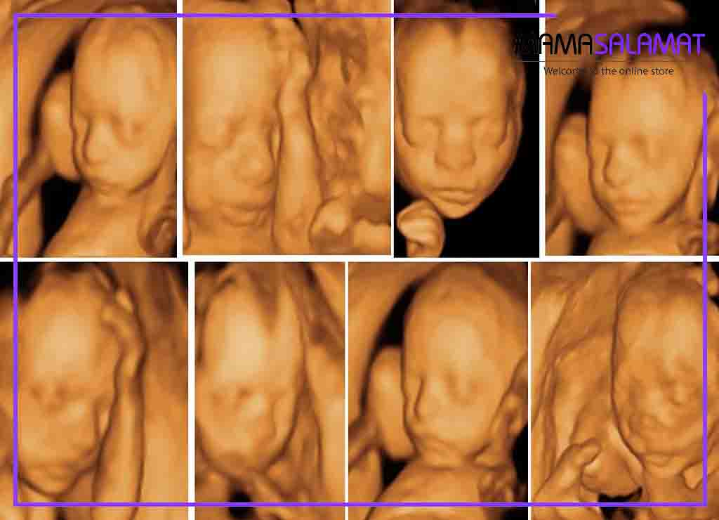 سونوگرافی آنومالی اسکن تصویر سه بعدی جنین