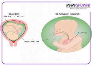 دفع مکونیوم جنین-آسیب مکونیوم به ریه نوزاد