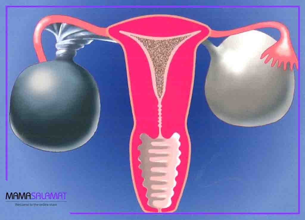 کیست تخمدان در بارداری-پیچ خوردگی کیست