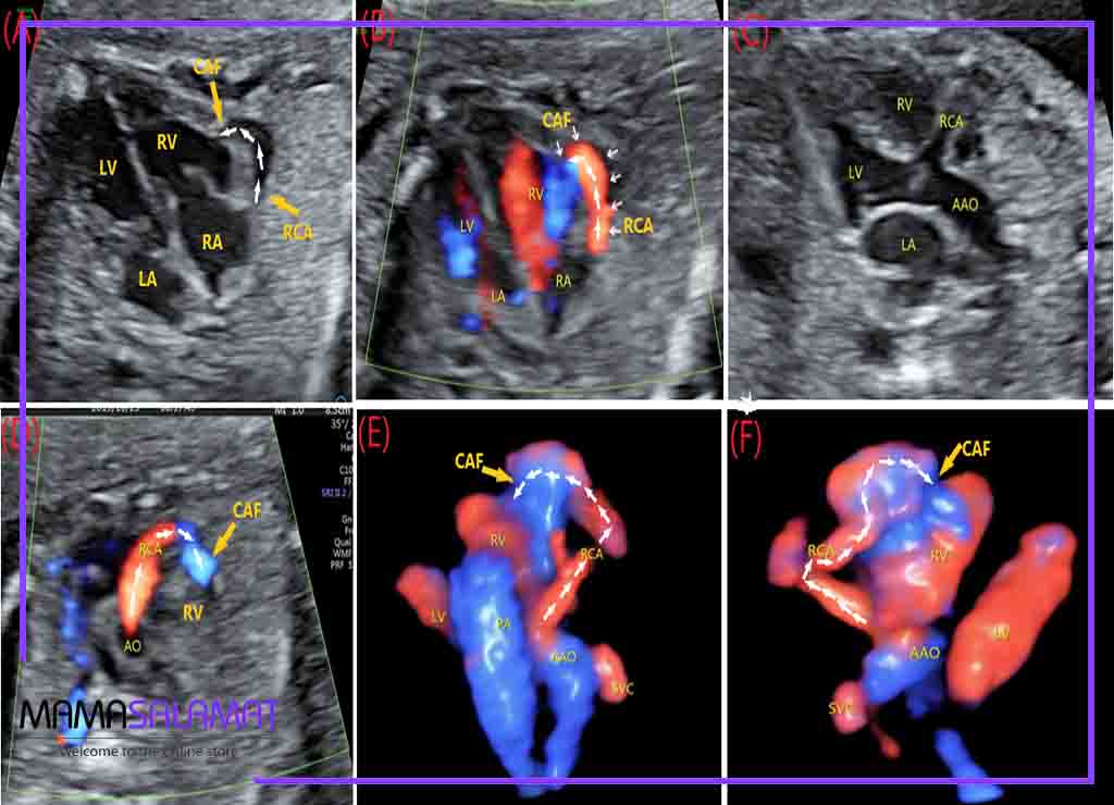 علت تشکیل نشدن قلب جنین تصویر سونوگرافی مراحل رشد قلب جنین
