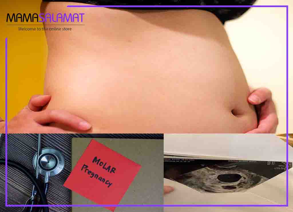 بارداری پوچ-حاملگی مولار