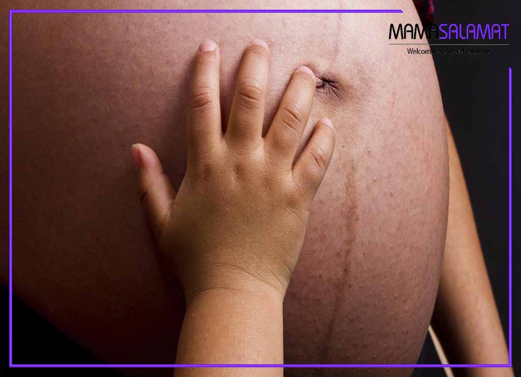 تیره شدن پوست در بارداری دست کودک بر روی شکم مادر باردار