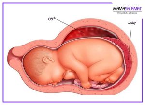 هماتوم بارداری تصویر جنین و هماتوم