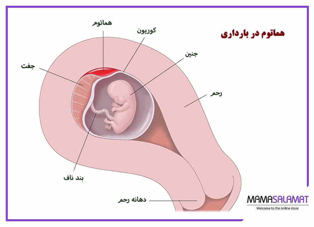 هماتوم در بارداری تصویر نشان دهنده رحم هماتوم جنین