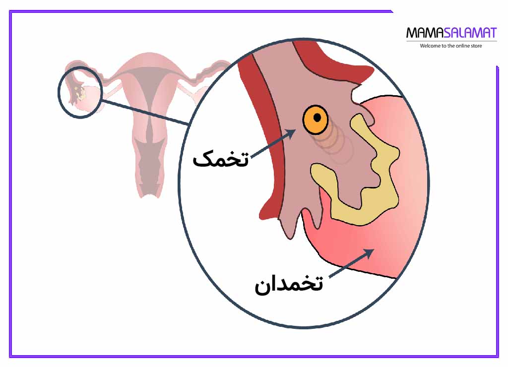 فولیکول تخمدان رحم و تخمدان